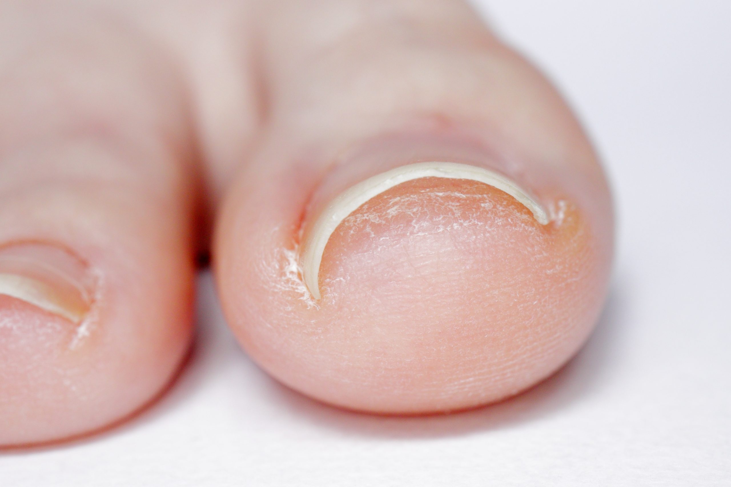 Ingrown Toenails 